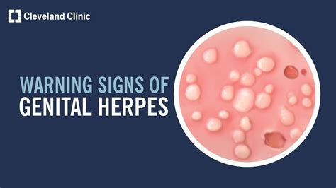 herpes in penus|Genital Herpes Symptoms, Pictures, and Treatment